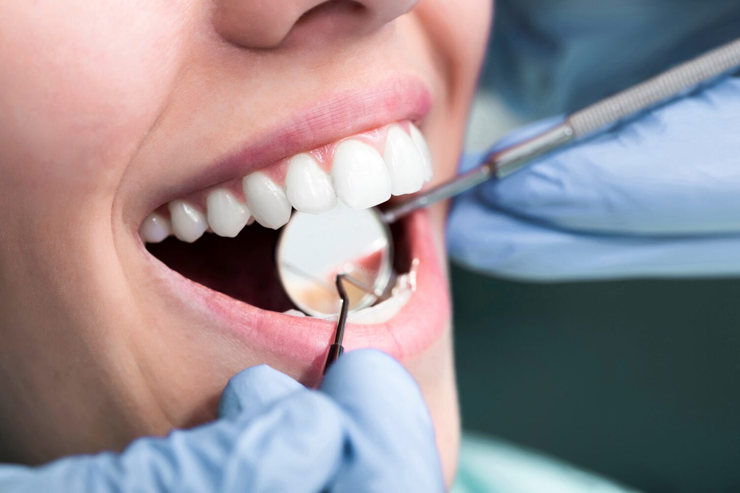 Alimentação e Clareamento Dental O Que Saber